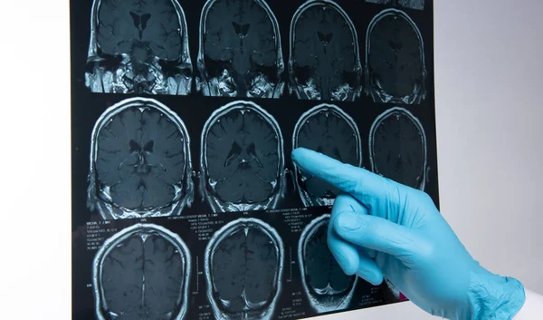 Doctors reviewing brain x-rays;MRI of the blood vessels in the brain and cerebrovascular disease or hemorrhagic stroke.