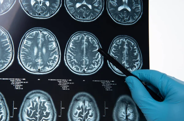 Doctors reviewing brain x-rays;MRI of the blood vessels in the brain and cerebrovascular disease or hemorrhagic stroke.