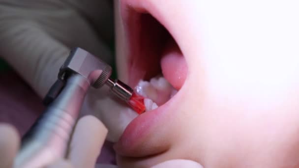 Zbliżenie Zdjęcia Polerowania Zębów Dzieci Profesjonalnym Sprzętem Dentystycznym Dentysta Dziecięcy — Wideo stockowe