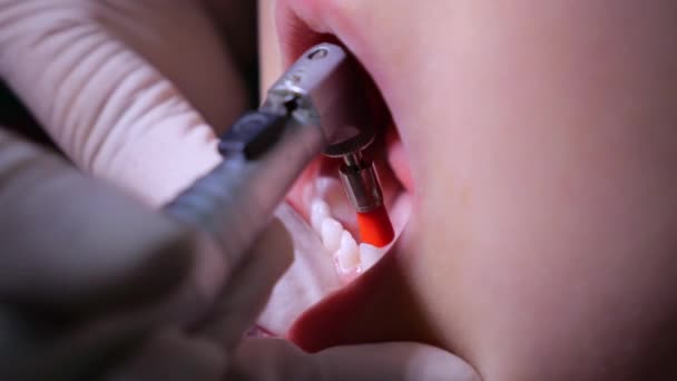 小児歯科医の歯磨き手術中に口を開いた子供 歯科医は穏やかに子供の唇を保持し 歯科用ドリルで歯の内側に優しく磨きます 歯医者で静かな歯磨きコンセプト — ストック動画