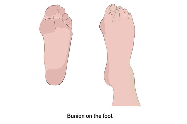 Bunion Foot Causes Base Toe Pushed Out Its Normal Position — Stock Vector