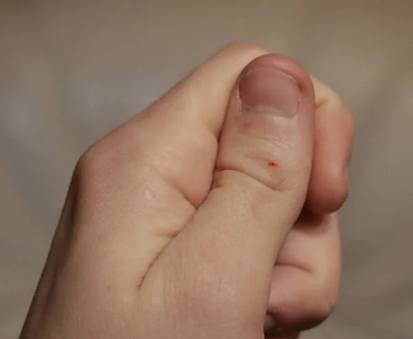A cut on a man\'s finger