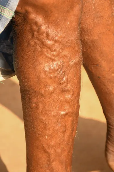 Varisli bir erkek bacağı. Sağlık sorunları, trombofili sorunları.