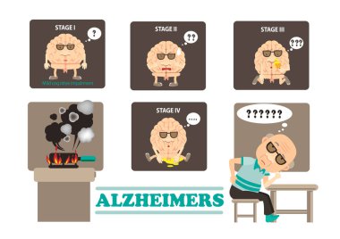 Alzheimer hastalığı bilgi grafiklerinin aşamaları. Vektör illüstrasyonu