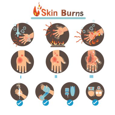 Deri yanıkları Derece Burns ve Termal Yanık Tedavisi, Vektör Çizimleri