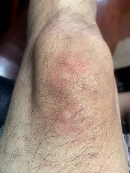 Also biting the skin. Scars of mosquito bites on the skin of an elderly man. The treatment is to apply anti-itch medication. Mosquito bites require immediate application of medication to reduce itching.