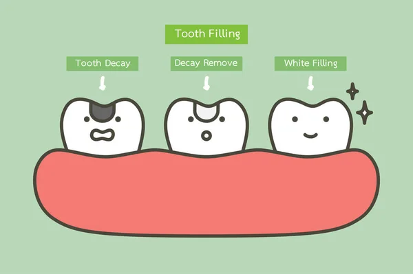 Passo Enchimento Amálgama Dente Por Ferramentas Dentárias Para Dente Decadência —  Vetores de Stock