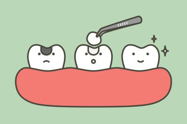 diş amalgam dolgu diş aletleri ile diş aletleri ile dolgu adım çürüme diş, öncesi ve sonrası - diş karikatür vektör düz stil tasarım için sevimli karakter