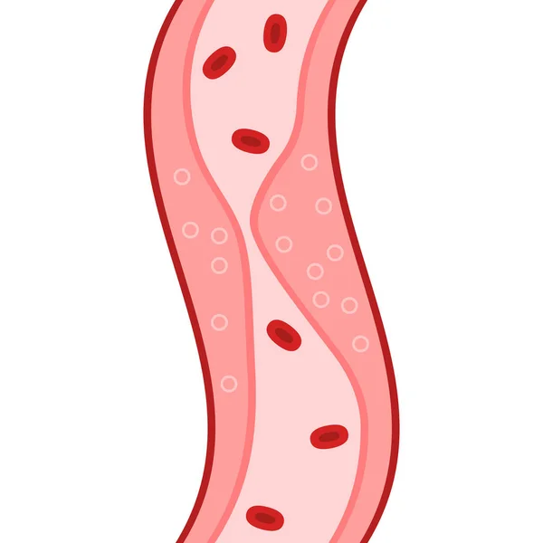 Tett Arterie Med Blodplater Kolesterolplakk Kolesterol Typer Betydning Forebygging Behandling – stockvektor