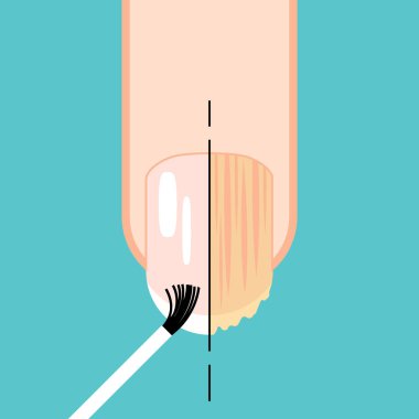 Mantar tırnağı. Mantar hastalığından önce ve sonra çivi. Mantar ve normal tırnak vektörü çizimi. Tırnak hastalıkları. Onychomycosis, mantar enfeksiyonu nedenleri, tedavi ikonu