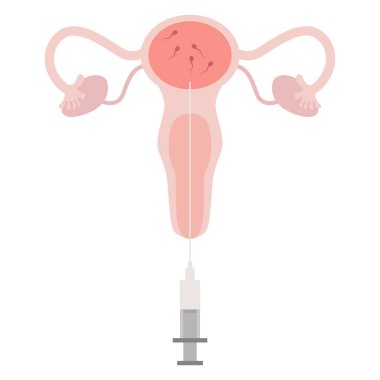 IUI tedavisi, rahim içi döllenme, donör sperm servisi. Yumurta hücreli hamile illüstrasyonu. Sperm hücresi poster kliniği için iyi. Rahim içi döllenme IUI