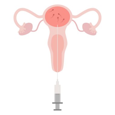 IUI treatment, Intrauterine insemination, Donor sperm service. The planing pregnant Illustration with egg cell, sperm cell good for poster medical clinic. Intrauterine insemination IUI clipart