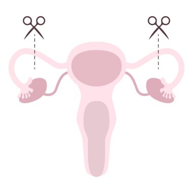 Tubectomy Reversal. Tubal ligation or surgical procedure tubectomy in operative gynecology concept. Tubal ligation and tubectomy - reproductive female and woman organ after sterilization clipart