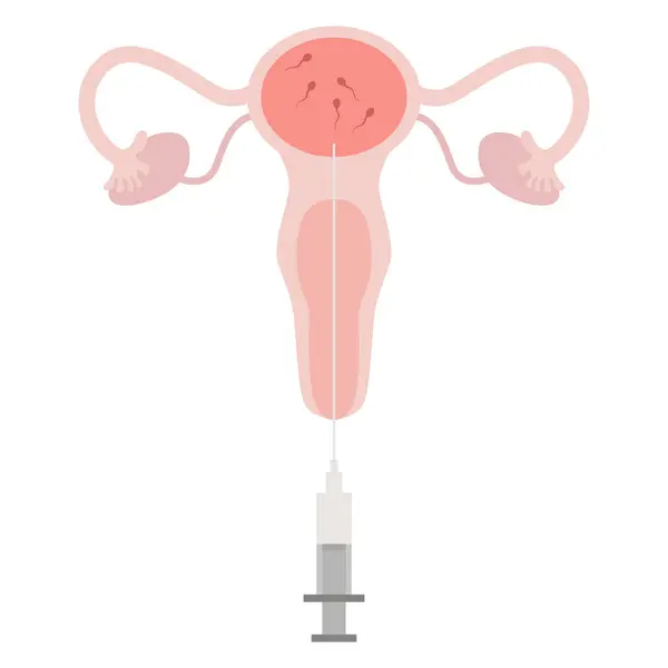 Tratamiento Inseminación Intrauterina Servicio Esperma Donante Cepillado Embarazada Ilustración Con Ilustración De Stock