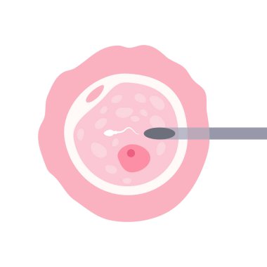 Intracytoplasmic sperm injection (ICSI). Intracytoplasmic sperm injection, ICSI, as part of IVF process clipart