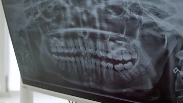 Radiografías Dentales Panorámicas Consultorio Del Dentista — Vídeo de stock