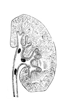 Orgelbrand, 1890, Warszawa 'dan Encyklopedya Medycyny' nin böbreklerindeki taşlar