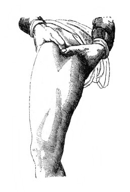 1890 'da Orgelbrand, Warszawa' dan Ansiklopedi Medycyny 'nin eski kitabındaki yaraya parmaklarını bastırarak kanamayı durdur.