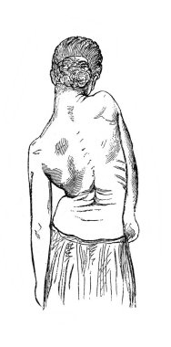 Eski kitap Encyklopedya Medycyny 'deki omurga eğriliği Orgelbrand, 1890, Warszawa