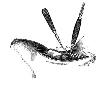 Trakea, Orgelbrand 'dan Ansiklopedi Medycyny' nin eski kitabını kesiyor. 17, 1890, Warszawa