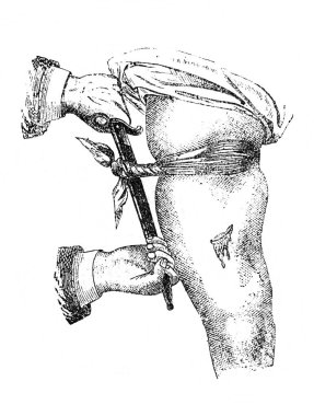 Orgelbrand, 1890, Warszawa 'dan Ansiklopedi Medycyny' nin eski kitabında kanamayı durdurma yöntemi