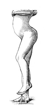 Orgelbrand 'ın Encyklopedya Medycyny' sindeki leğen kemiği ve bacakların eğriliği, vol. 17, 1890, Warszawa