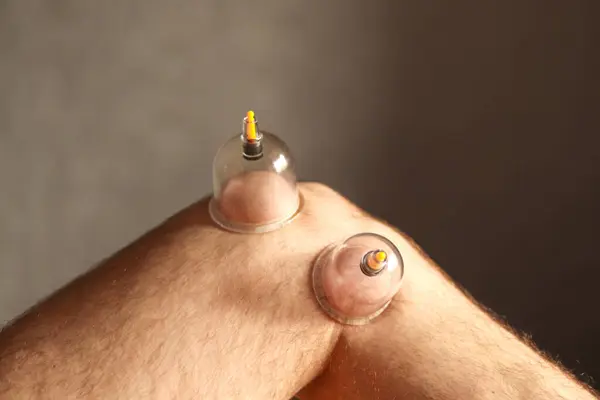 Cupping therapy. Cup vacuum massage. Cups for massage on the man's leg.