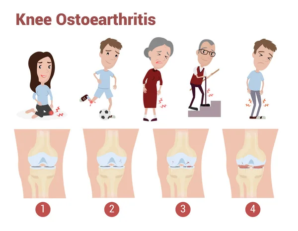 膝关节骨关节炎信息图解释成人和老年人的疼痛 膝关节疼痛和关节疼痛 — 图库矢量图片