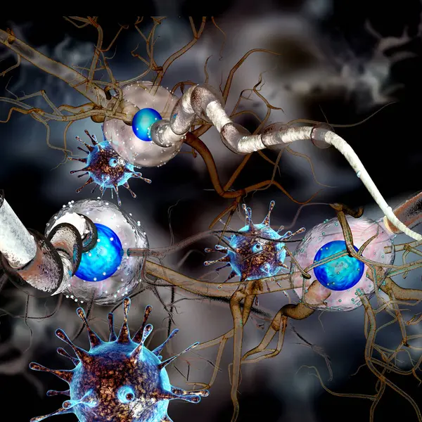 Komórki Nerwowe Neuron Choroba Neurologiczna Guzy Operacja Mózgu Ilustracja — Zdjęcie stockowe