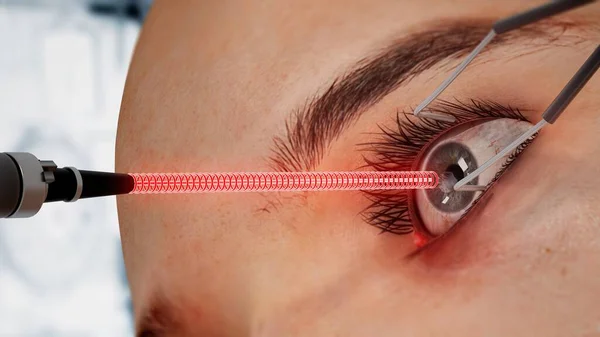 Laser eye surgery on 3D CGI character. 3D illustration.