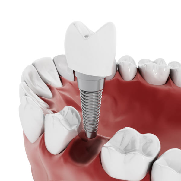 Diş implant diş yapısı gösteren çizim