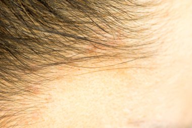 Saç çizgisi ve kafa derisi yakından, dermatolojik hastalıklar, deri problemleri.