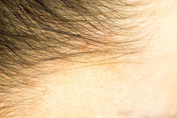 Hajvonal Fejbőr Közeli Bőrbetegségek Bőrproblémák — Stock Fotó