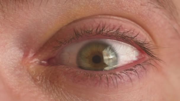 Bilgisayarda Çalıştıktan Sonra Yorgun Gözler Konjonktivitten Gripten Soğuk Algınlığından Alerjiden — Stok video