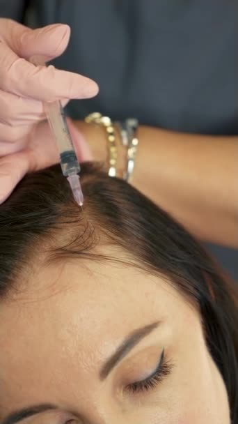 Ενέσιμο Μαλλιών Σύριγγα Στο Κεφάλι Ενέσεις Πλάσματος Κατά Της Τριχόπτωσης — Αρχείο Βίντεο