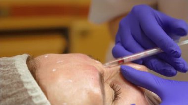 Tedavi enjeksiyon prosedürü. Kadın yüz derisi için kozmetolojide şırınga kullanarak yaşlanma önleyici enjeksiyonlar. Kozmetik prosedürleri. Modern kozmetoloji kliniğinde botulotoksin enjeksiyonu prosedürü. Botulinyum