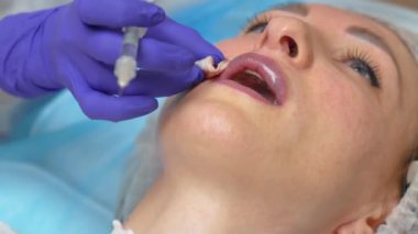 Doktor hastanın kanını durdurur. Dudaklarını büyütmek için ağız kenarındaki şırıngayı kullan. Güzellik uzmanları hyaluronik asit enjekte edildikten sonra kan dudaklarını pamukla silerler. Yaralı kadın