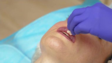 Yakından bakınca, dudaklarının hacmini arttırmak için hyaluronik dolgu malzemesi kullanıldıktan sonra kanama ve çürükler görülüyor. Estetik kozmetik kliniğinde dudak büyütme enjeksiyonu. Güzellik bezi.
