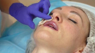 Kozmetikçiler kanamayı durdurmak için hyaluronik dolgu yapınca dudaklarını pamukla alkolle silerler. Dudak büyütme ameliyatında acı çeken bir kadın. Enjeksiyon