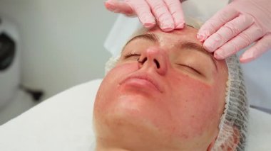 Yüz terapisi sırasında eldivenli ellerle nazikçe tedavi edilen kırmızı bir kadın derisi. Kadın profesyonel, hassas cilt ve dikkatli hareketler. Sinirli bölgeleri sakinleştirmeye odaklanan uzman
