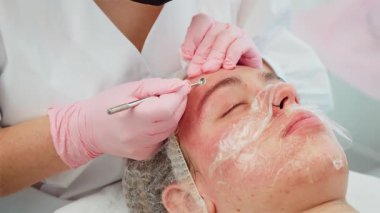 Özel cilt bakımı ile ergen sivilcelerini aldırmak. Eldivenli eller hijyenik yaklaşımı sağlarken etkili tedavi için hassas araçlar kullanır. Daha açık cilt gelişimi için sorunlu alanları ele alan kozmetoloji çözümü
