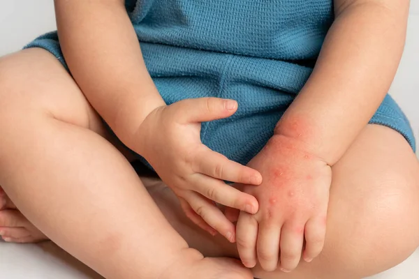 Asiatiskt Barn Har Röda Svullna Och Blåsor Handen Orsakade Insektsbett Stockbild