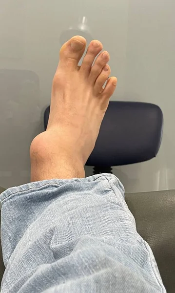 Mans foot with swollen ankle malformation, lying on a medical clinic stretcher after having an accident. High quality photo
