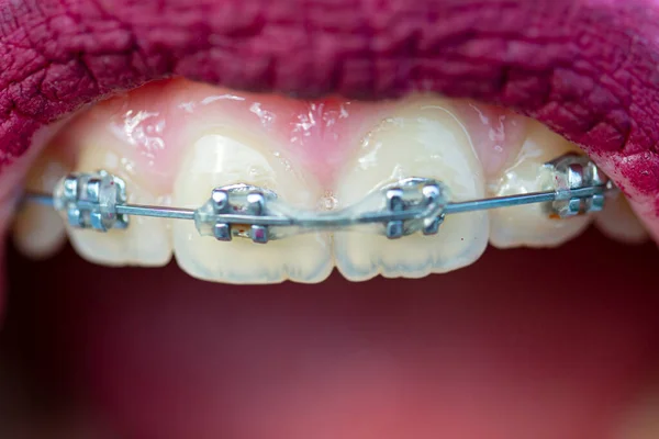 ブレースが閉じます 白い歯 歯のマクロの背景 歯のケア 健康的な歯と笑顔 口の中で白い歯 — ストック写真