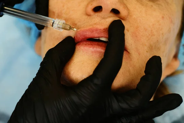 Closeup woman lips, procedure augmentation. Syringe female mouth, hyaluronic acid injection, augmentation. Age changes. Cosmetology Treatment