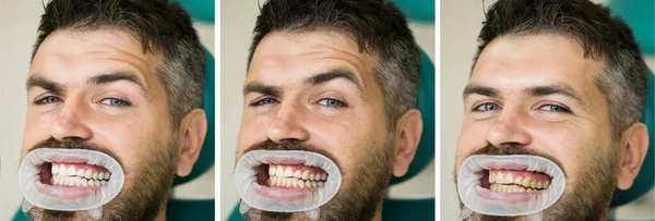 Mężczyzna Białym Tle Białe Zęby Przed Koncepcji Koncepcja Stomatologia Zbliżenie — Zdjęcie stockowe
