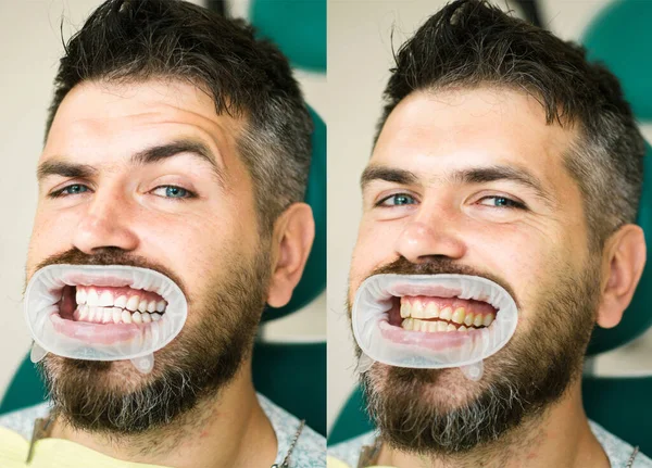 White teeth - before and after concept. Close-up detail of man teeth before and after whitening. Result of teeth whitening. Perfect smile after bleaching