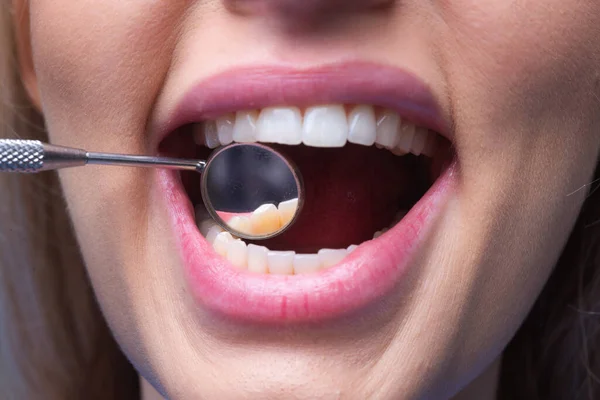 歯は歯科医で検査された 健康な女性の歯と歯医者の口ミラー 理想的な歯だ 歯の道具 歯の鏡で女性の歯を閉じてください 歯科治療 歯科医院のコンセプトで歯科医 — ストック写真