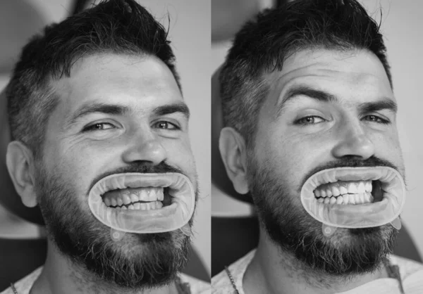 白色牙齿 之前和之后的概念 人的牙齿在美白前后的特写细节 牙齿美白的结果 漂白后的完美微笑 — 图库照片
