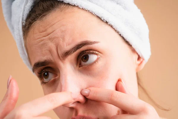 女性はにきびを絞る顔を閉じます 若い女性ににきびシミ肌 スポット瘢痕にきび そばかす およびメラーマ色素沈着皮膚の顔の治療 問題の肌の概念 — ストック写真